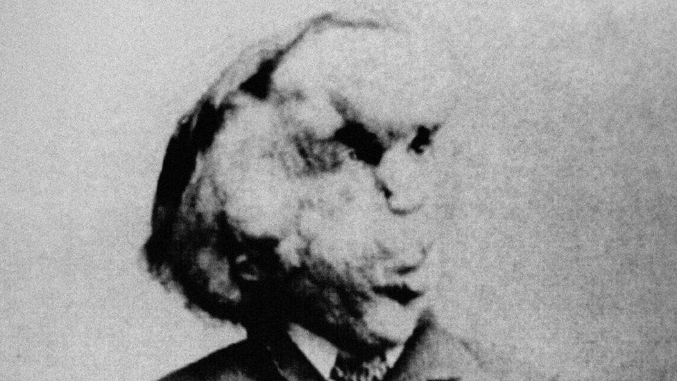 Joseph Carey Merrick, known as the Elephant Man, is shown in a photo from the Radiological Society of North America