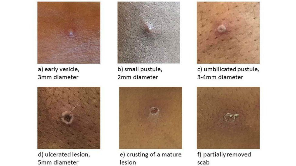 Images showing stages of a monkeypox rash with different types of pustule.