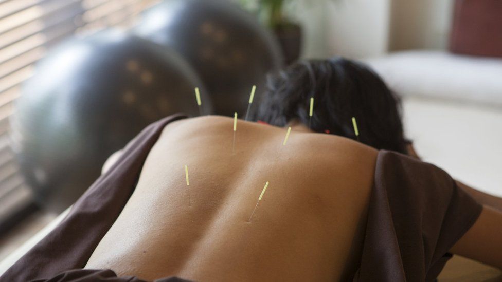 An adult having acupuncture