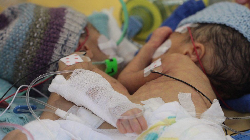 'Youngest' conjoined sisters separated at Swiss hospital in Bern - BBC News