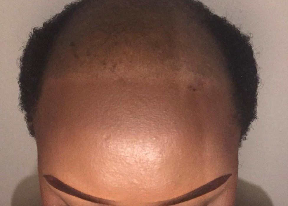 Why Do Men Go Bald and What Can You Do About It?