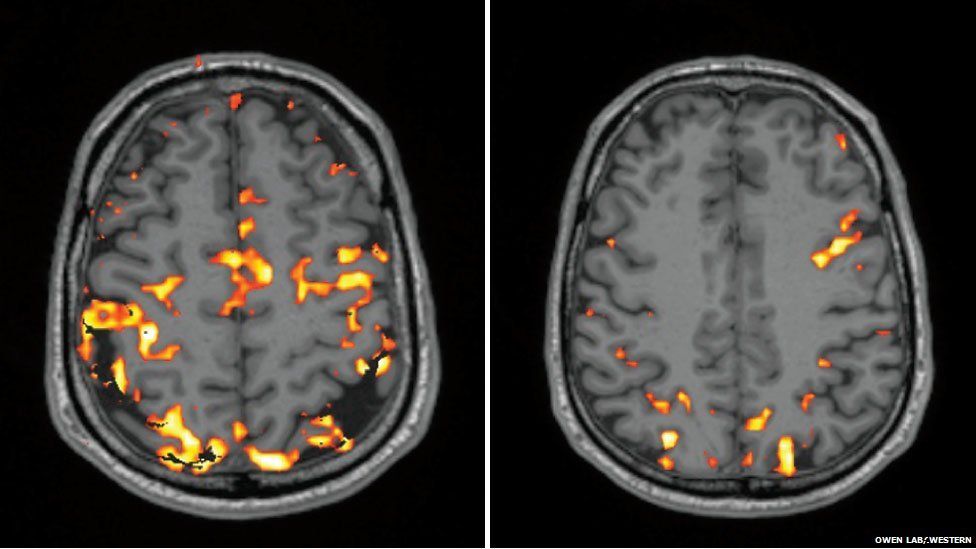 How lack of sleep affects the brain - BBC News