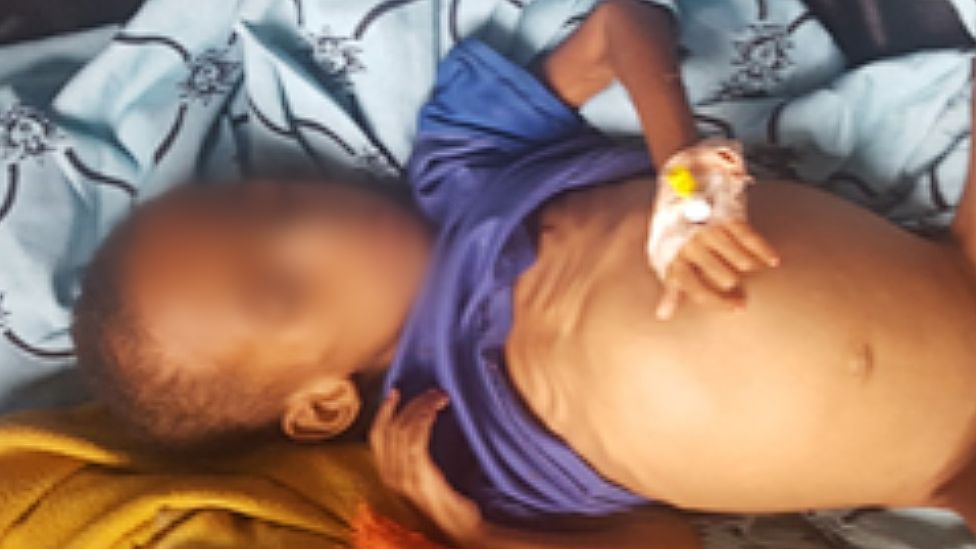 Недоедающий ребенок недавно сфотографирован в больнице Айдер в Мекелле, Тигрей в Эфиопии
