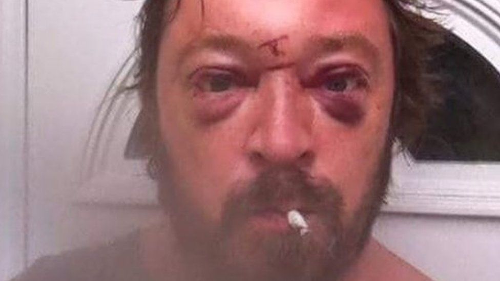Selfie photo shows Gene's head injuries after his drunken fall from a bunkbed