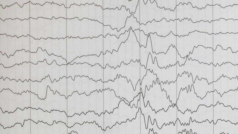 Encefalograma epilepsia.