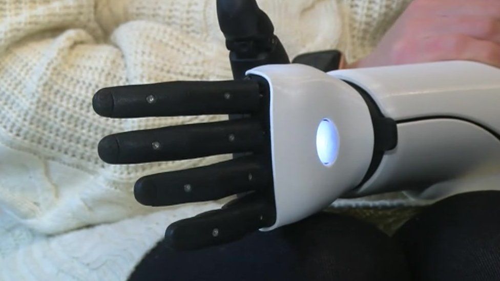 Kate's 3D printed bionic arm improved her health - and her confidence