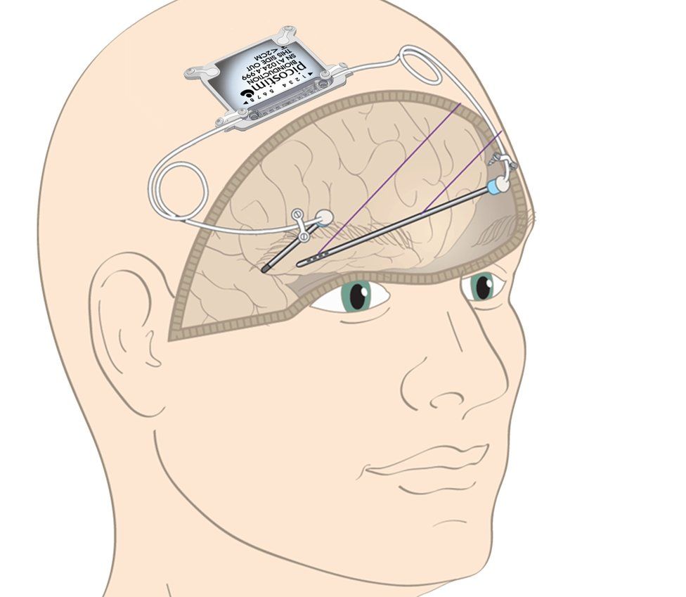 Un gráfico de una cabeza que muestra dónde se ubica el implante en la parte superior del cráneo y dónde se ubican los electrodos cerebrales