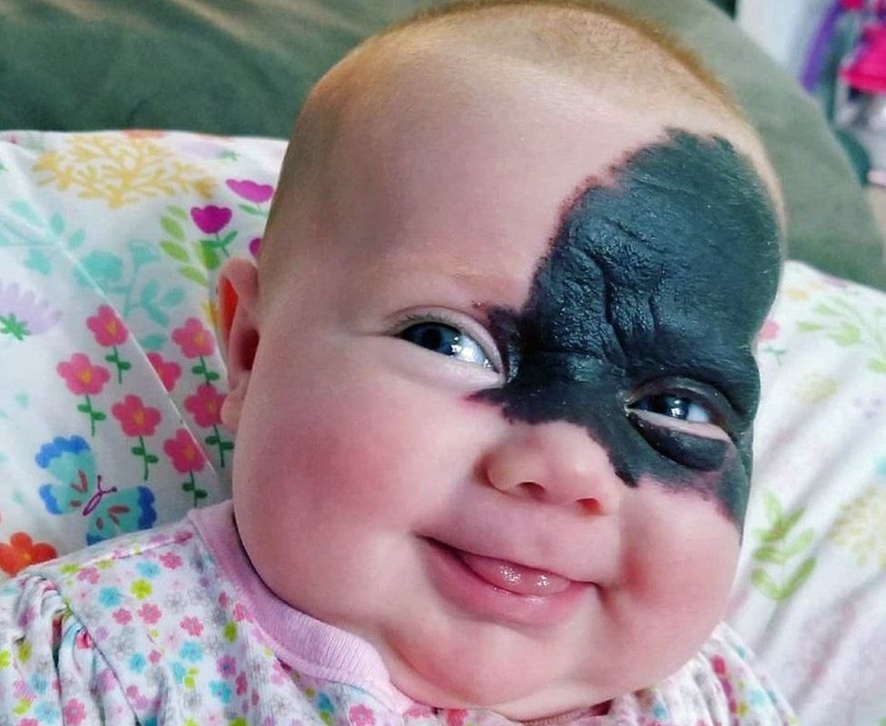 Republikeinse partij Knooppunt Intact Baby dubbed 'little superhero' due to Batman-like birthmark - BBC News