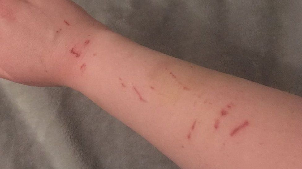 Scratches and bruises on Emma's arm