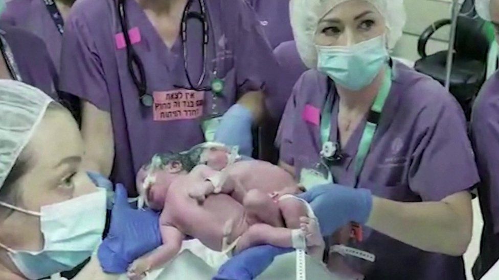 ISRAEL: Twins conjoined at head separated after rare surgery - Naija Times