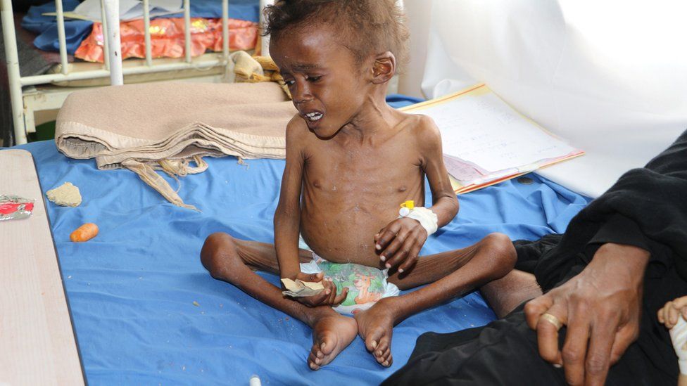 Jamal Mujalli al-Mashriqi, 4, who suffers from malnutrition, sits on a bed at a hospital in the northwestern city of Saada