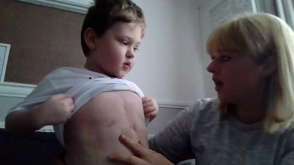 Brayden showing scar to mother