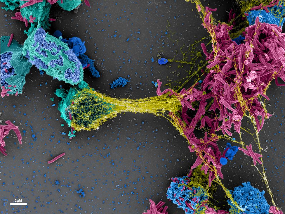 Cells destroying tuberculosis