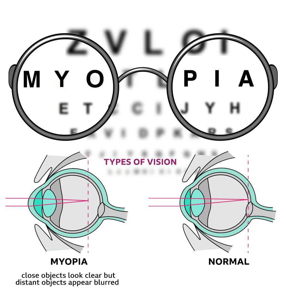 stabiliza miopia