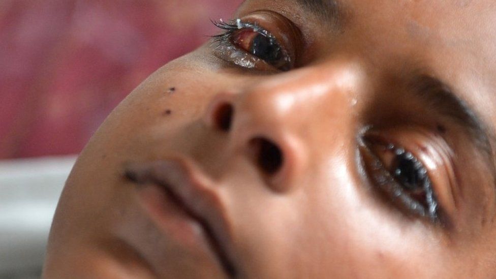 A wounded Kashmiri boy, with an injured eye, after being hit by pellets fired by Indian security forces during a protest, in a Srinagar hospital on July 13, 2016