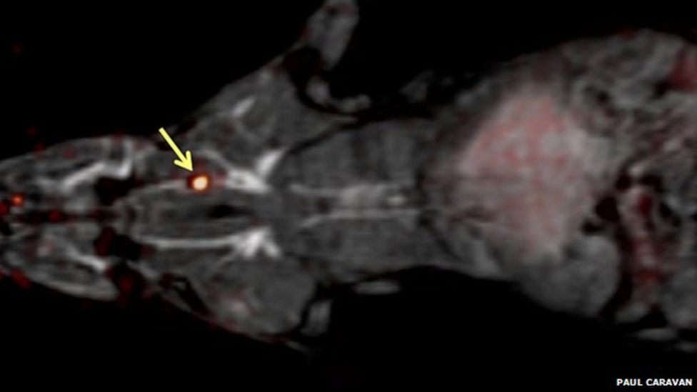 New probe 'lights up' blood clots in single scan BBC News