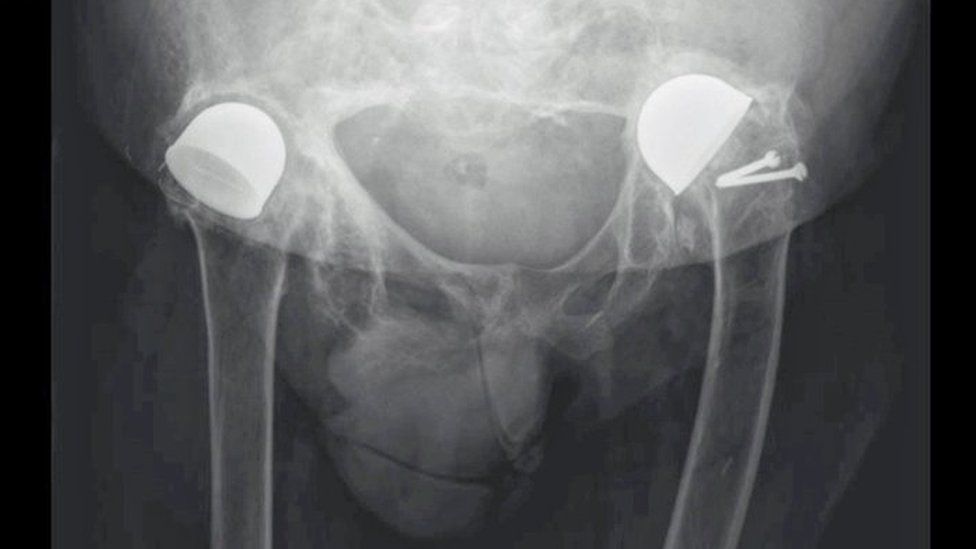 X-ray of Norman Sharp's hips