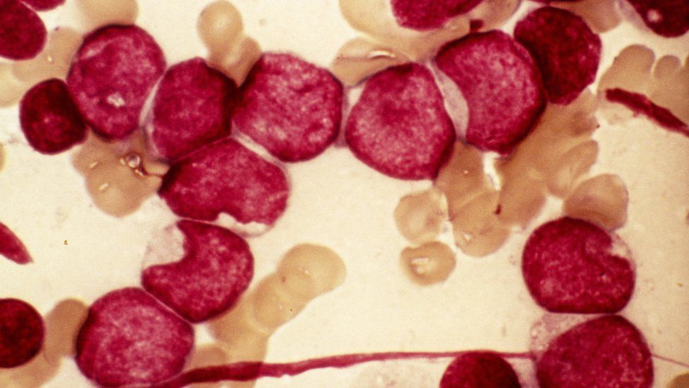 Blood cells from bone marrow in a case of acute myeloid leukaemia (AML)