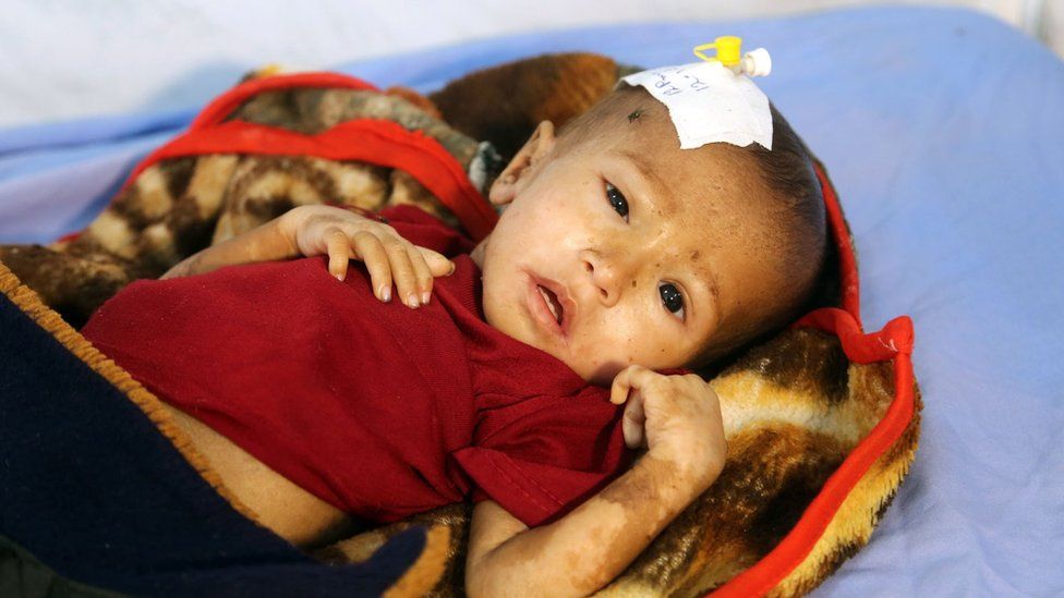 A malnourished Yemeni child receives treatment at a hospital in the Yemeni port city of Hudaydah (16 January 2018)