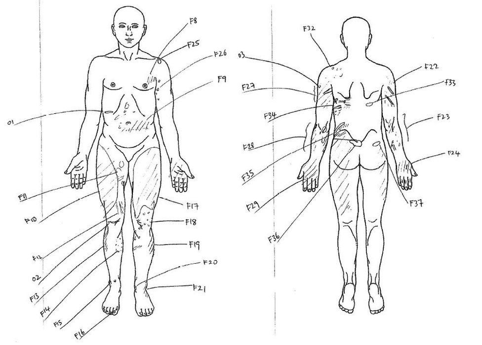 Body map showing Tara Newbold's body injuries