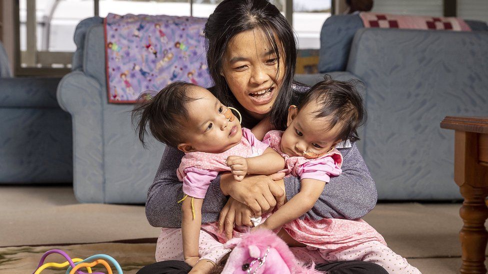 Bhumchu Zangmo holds her conjoined twins Nima and Dawa in Australia