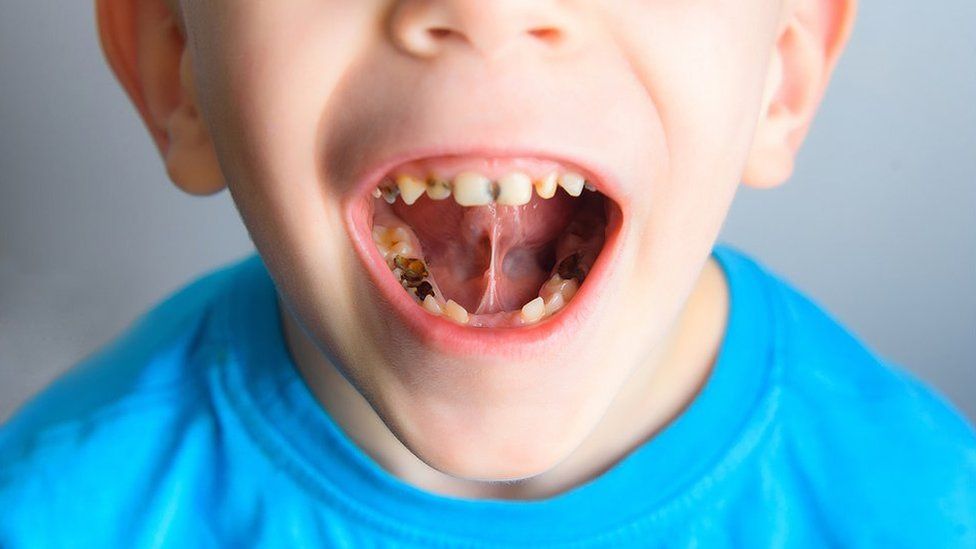enfermedad dientes oscuros