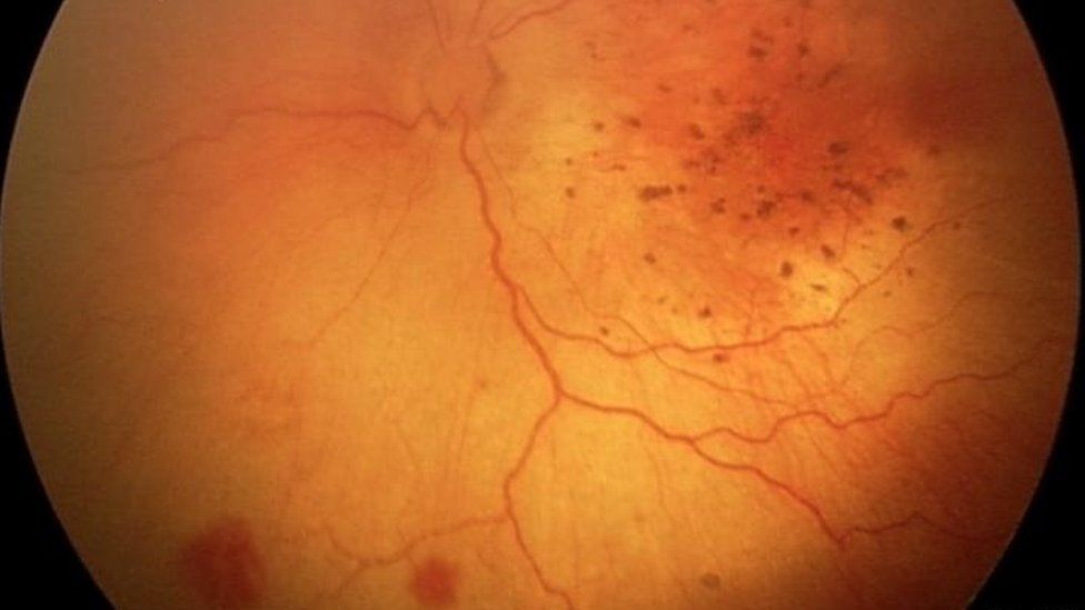 retinal haemorrhages