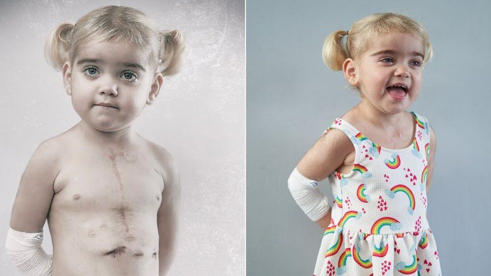 Two pictures of Grace, a two-year-old girl, one with her shirt off showing her heart transplant scars and the other in a rainbow-covered dress