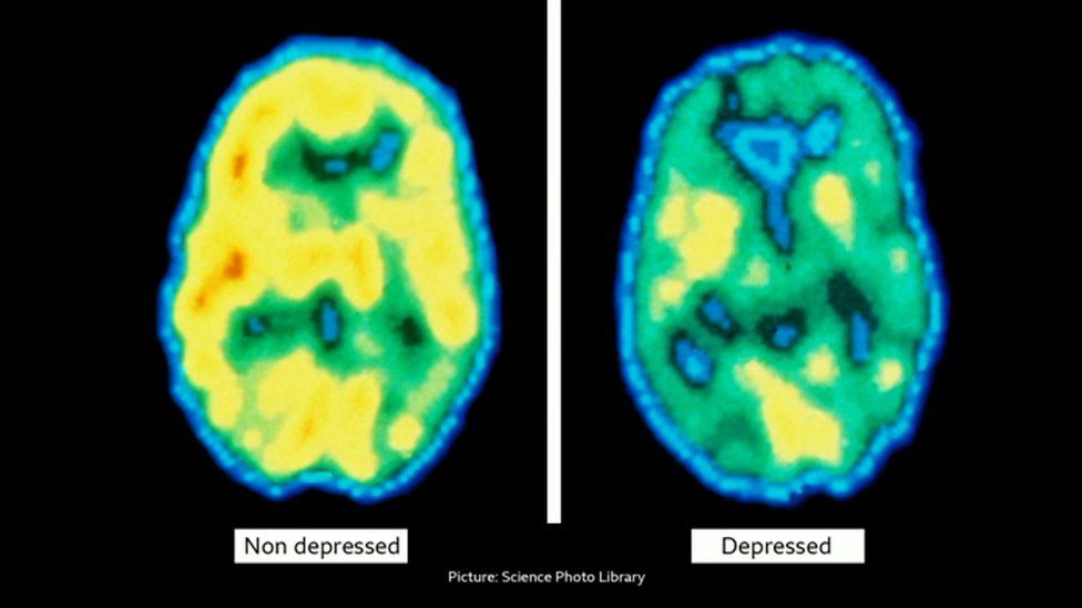 A brain scan showing how a depressed brain has less electrical stimulation than a brain without depression