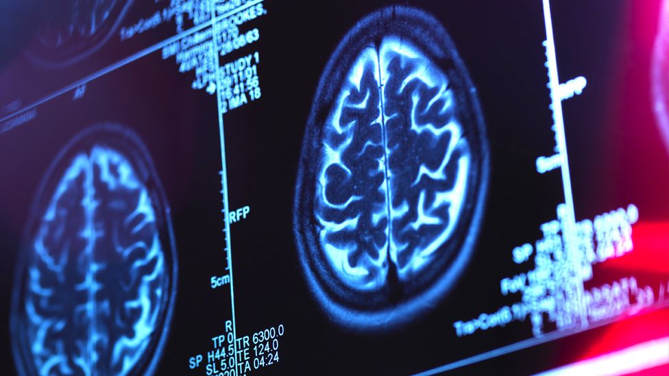 Stock image of a human brain scan in a neurology clinic