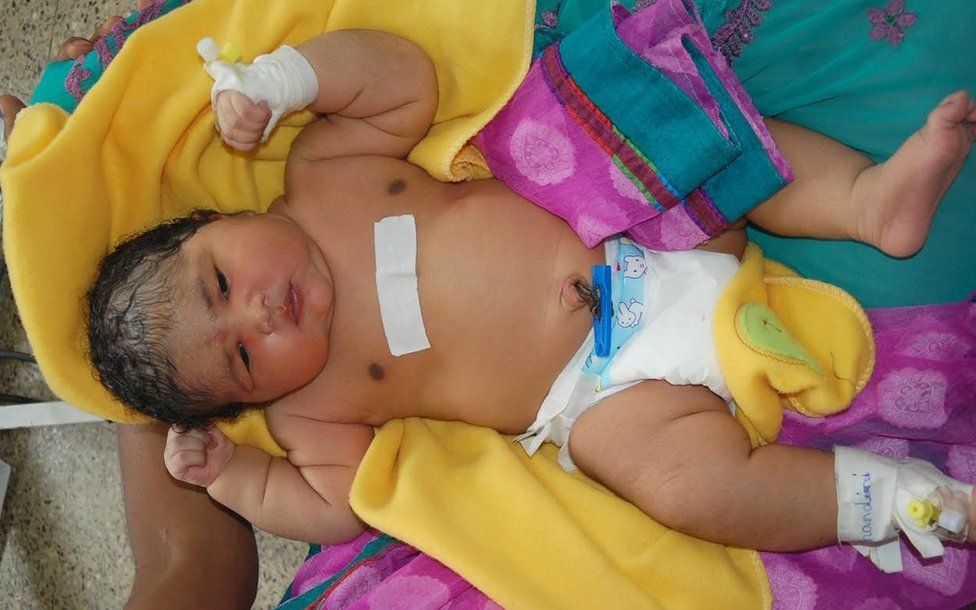 Mum Gives Birth To 'Heaviest Baby' In India, Weighing 15Lb - Bbc News