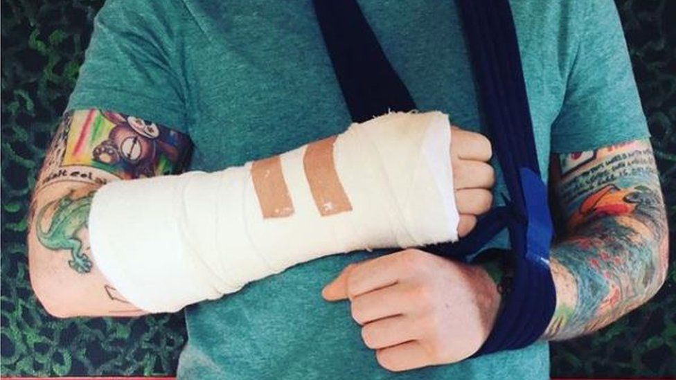 Ed Sheeran's broken arm