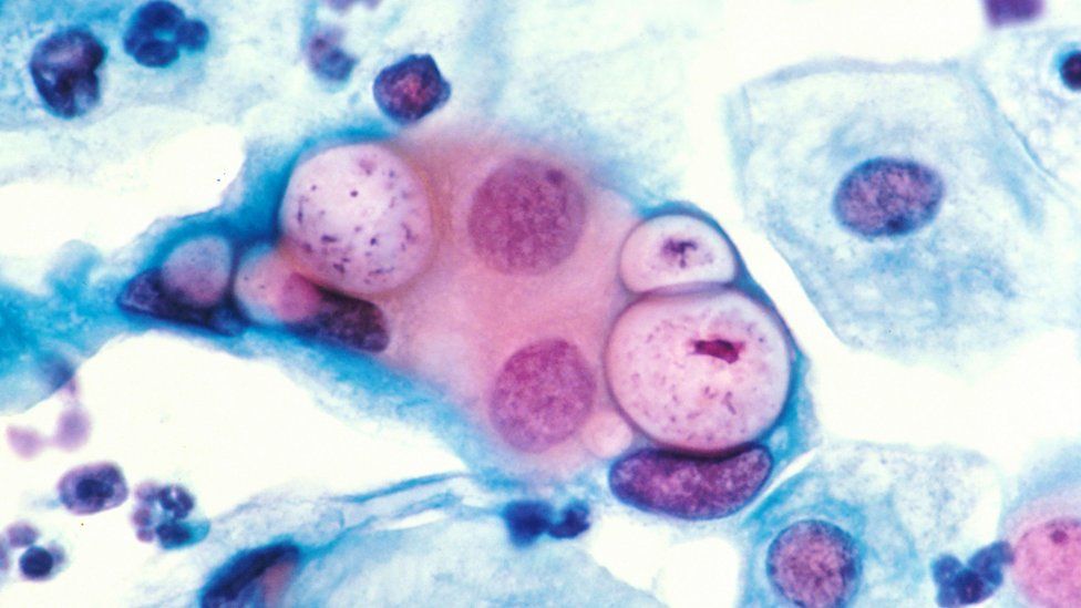 Human pap smear showing chlamydia