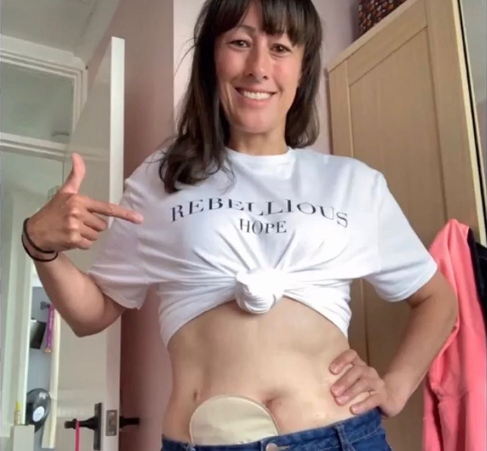 Laura with a dedication to the late campaigner and podcaster Dame Deborah James - and showing off 'Etna' - the nickname for her stoma