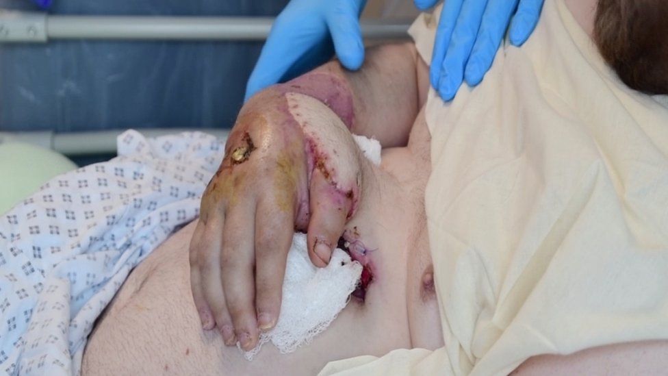 Martin Shaw's hand stitched to his abdomen