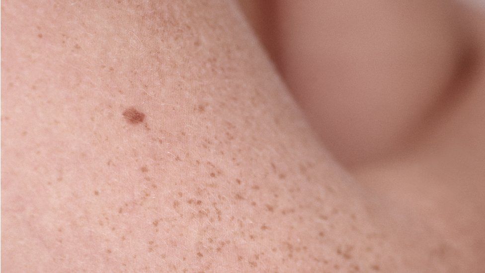 new-moles-and-what-to-look-out-for-medical-news-corner