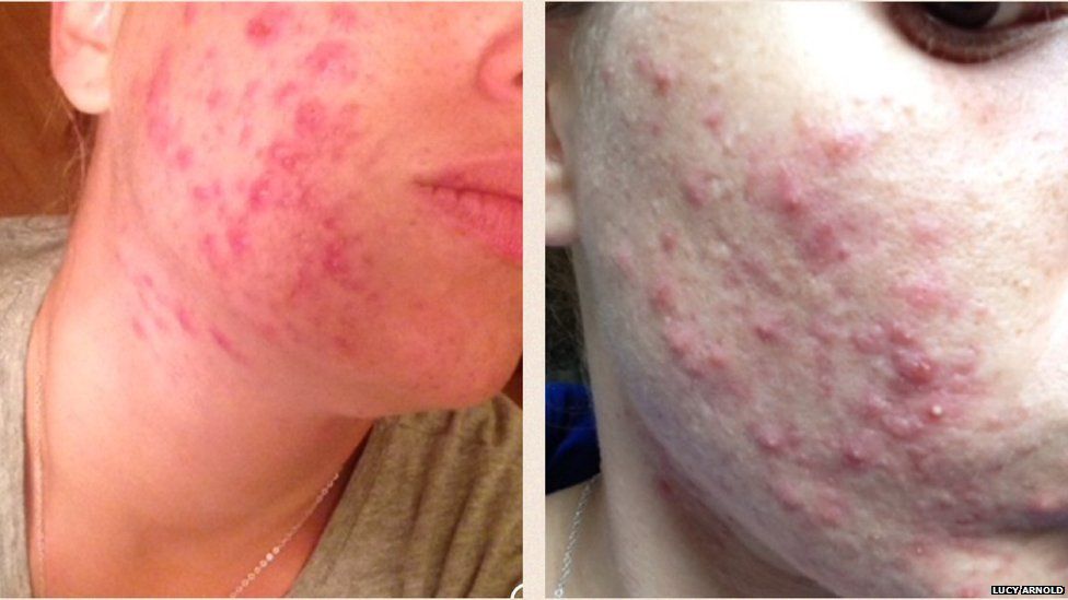 Lucy suffered with acne for three years.