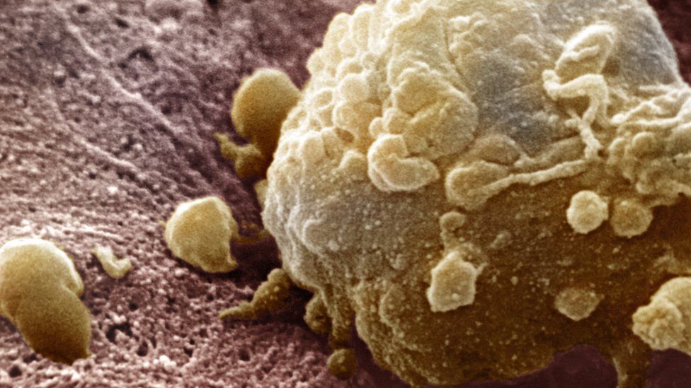 Клетки рака меланомы