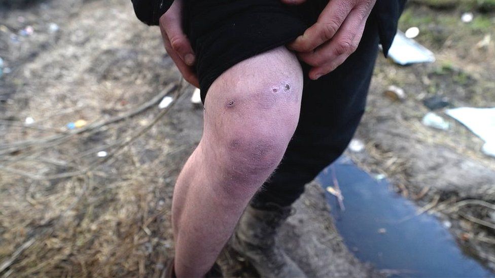 Image shows bullet wound to knee