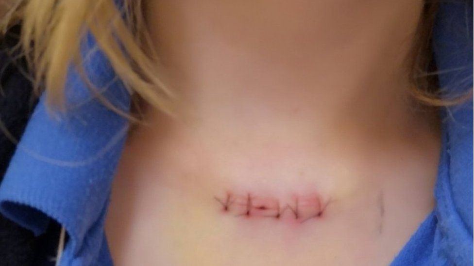 Darcy Shaw's scar