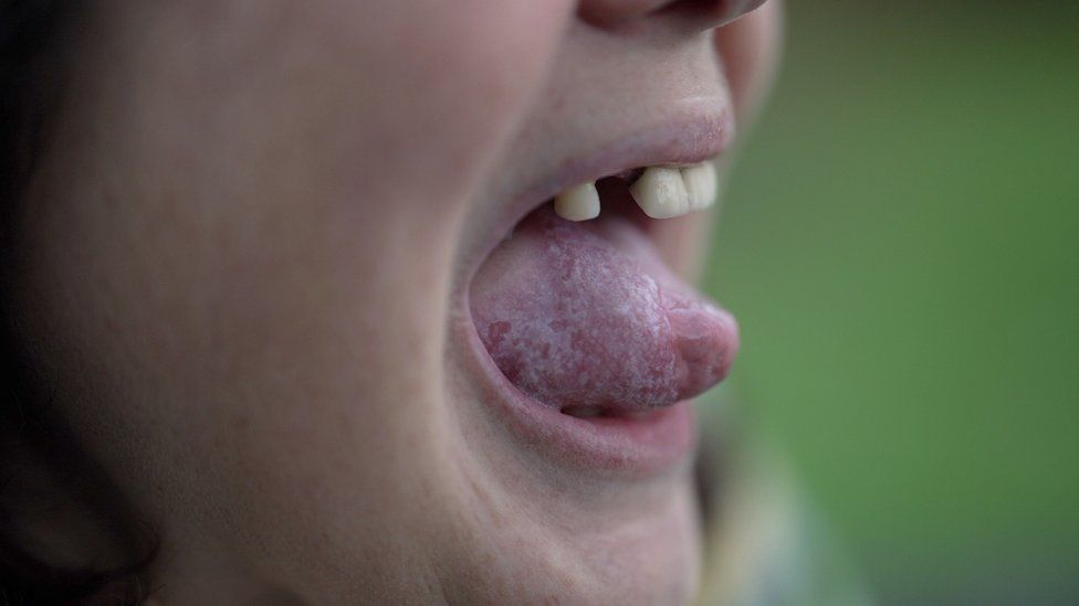 Sinead Marland was 39 when she noticed a lump on her tongue