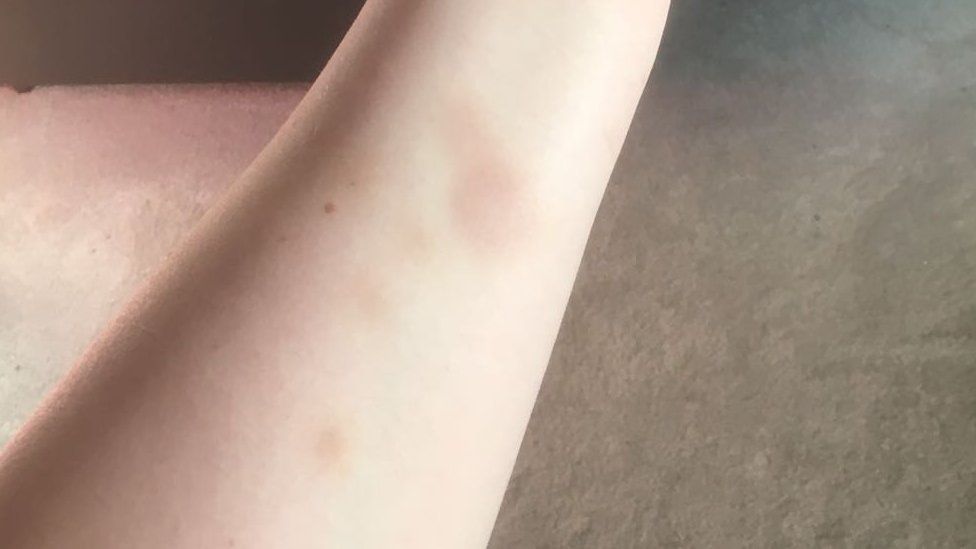 Emma's bruised arm