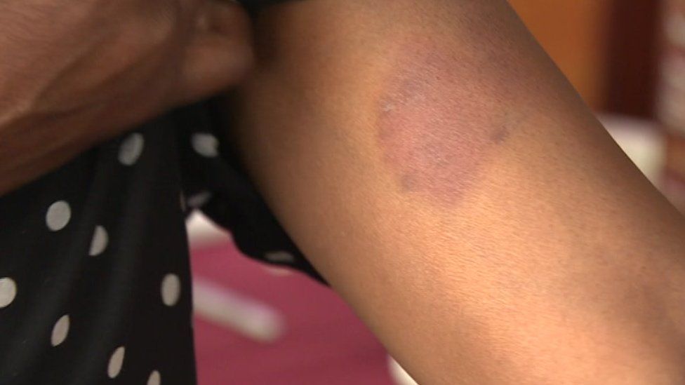 Victim's bruised arm