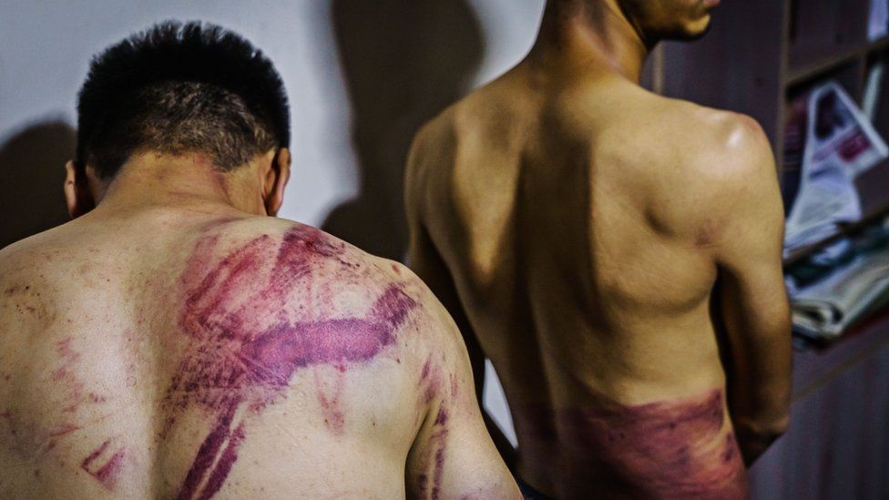 Journalists from the Etilaatroz newspaper, Nemat Naqdi, 28, a video journalist, left and Taqi Daryabi, 22, video editor undress to show their wounds sustained after Taliban fighters tortured and beat them while in custody after they were arrested for reporting on a womens rights protest in Kabul, Afghanistan, Wednesday, Sept. 8, 2021