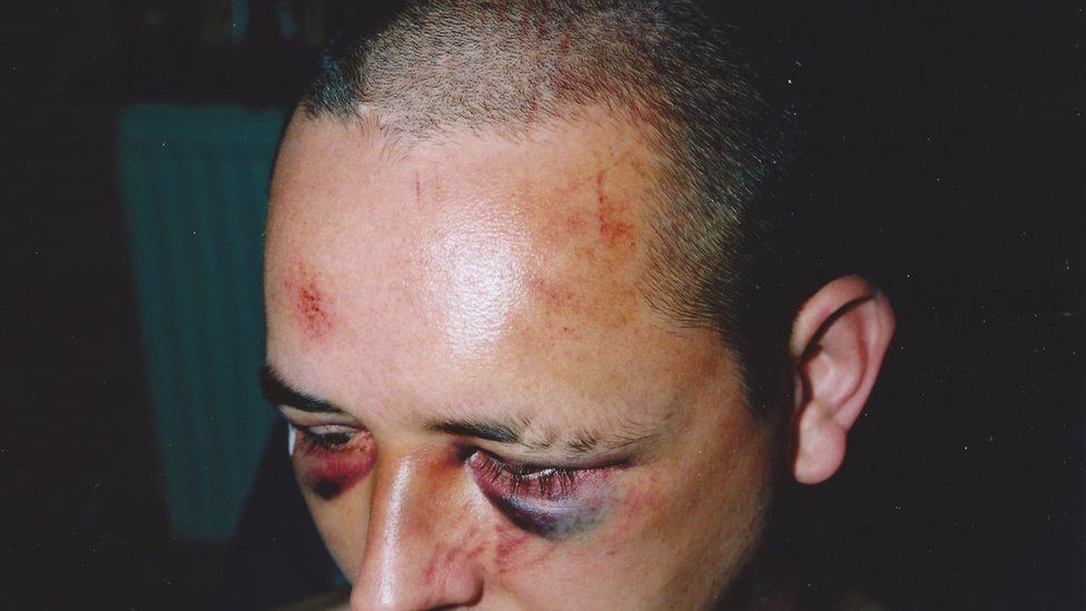 A picture of Colin's injuries taken 10 days after the attack