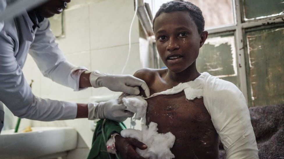 Тогога, получивший ранения среди жителей, деревни примерно в 20 км к западу от Мекеле, где предположительно в результате авиаудара обрушился рынок, в результате чего число жертв неизвестно, проходит лечение в больнице Айдер в Мекеле, столице региона Тыграй, Эфиопия, 23 июня. 2021