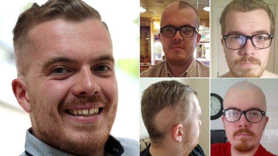 Nic Cumpilido and his different hair styles while being treated for cancer