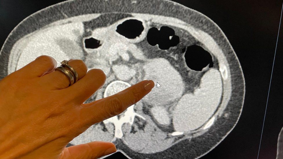 Tina's tumour is pointed out by a doctor on a scan