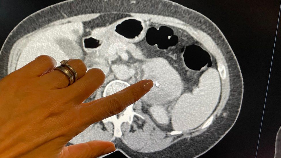 Promising new AI can detect early signs of lung cancer that doctors can't  see