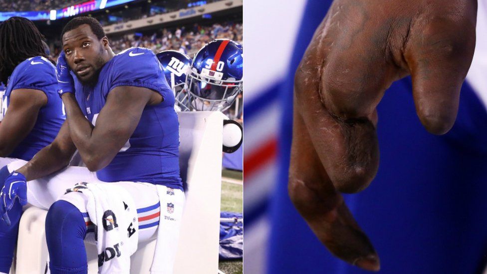Jason Pierre-Paul and his damaged hand